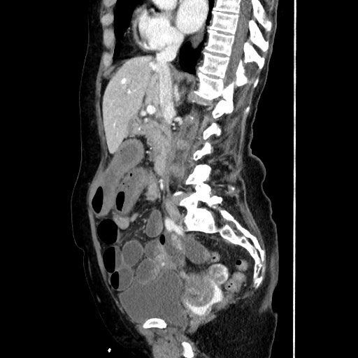 Closed loop small bowel obstruction due to adhesive band, with intramural hemorrhage and ischemia (Radiopaedia 83831-99017 D 94).jpg