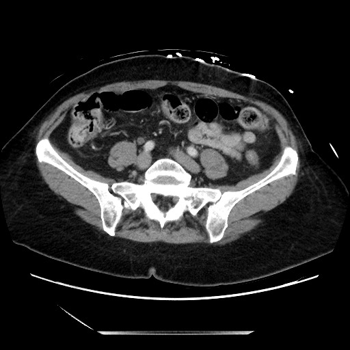 File:Closed loop small bowel obstruction due to adhesive bands - early and late images (Radiopaedia 83830-99014 A 103).jpg