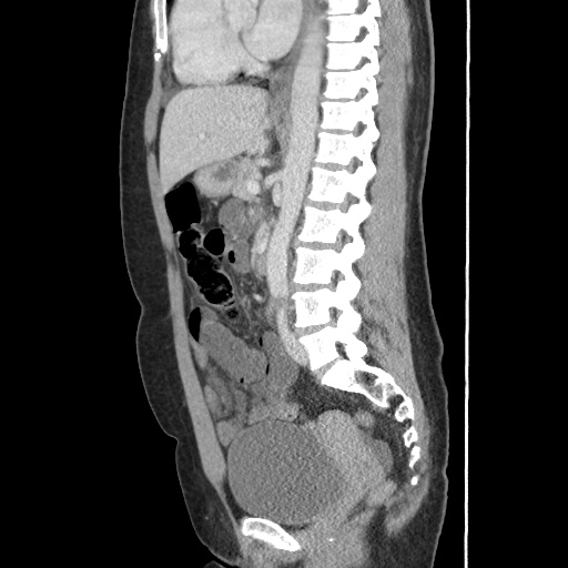 File:Closed loop small bowel obstruction due to trans-omental herniation (Radiopaedia 35593-37109 C 36).jpg