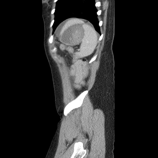 Closed loop small bowel obstruction due to trans-omental herniation (Radiopaedia 35593-37109 C 57).jpg