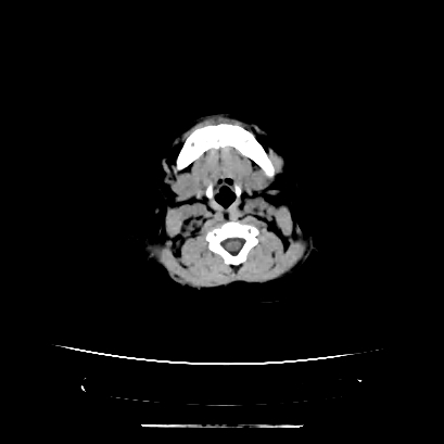 Cloverleaf skull (Radiopaedia 91901-109710 Axial non-contrast 23).jpg