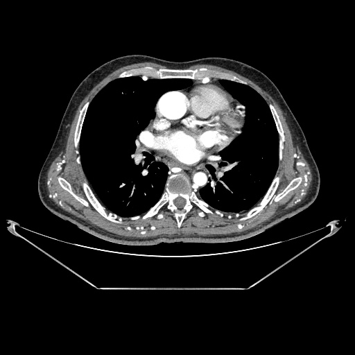 File:Coarctation of aorta (Radiopaedia 25384-25630 A 63).jpg