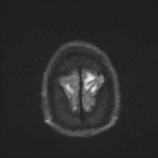Cochlear incomplete partition type III associated with hypothalamic hamartoma (Radiopaedia 88756-105498 Axial DWI 80).jpg