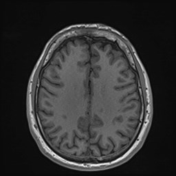 File:Cochlear incomplete partition type III associated with hypothalamic hamartoma (Radiopaedia 88756-105498 Axial T1 132).jpg