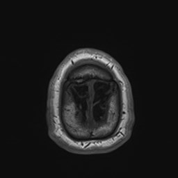 File:Cochlear incomplete partition type III associated with hypothalamic hamartoma (Radiopaedia 88756-105498 Axial T1 183).jpg