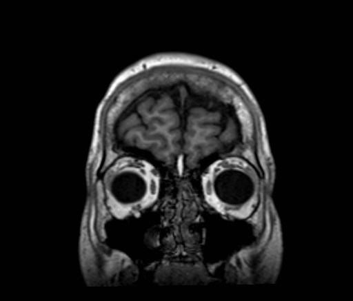 File:Cochlear incomplete partition type III associated with hypothalamic hamartoma (Radiopaedia 88756-105498 Coronal T1 56).jpg