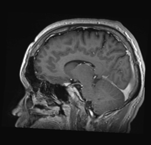 Cochlear incomplete partition type III associated with hypothalamic hamartoma (Radiopaedia 88756-105498 Sagittal T1 C+ 31).jpg