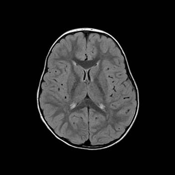File:Cochlear nerve aplasia - unilateral (Radiopaedia 87910-104413 Axial FLAIR 20).jpg