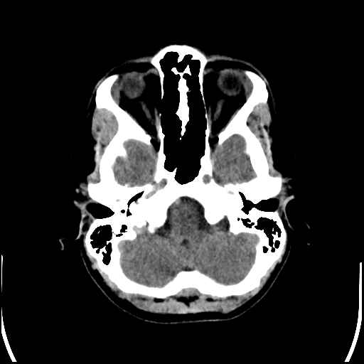 Colloid cyst (Radiopaedia 78104-90633 Axial non-contrast 21).jpg