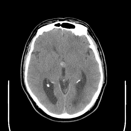 File:Colloid cyst (large) (Radiopaedia 34415-35734 Axial non-contrast 27).png