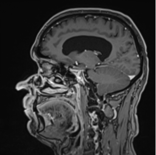 File:Colloid cyst of the third ventricle (Radiopaedia 86571-102662 Sagittal T1 C+ 46).png