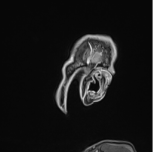 File:Colloid cyst of the third ventricle (Radiopaedia 86571-102662 Sagittal T1 C+ 76).png