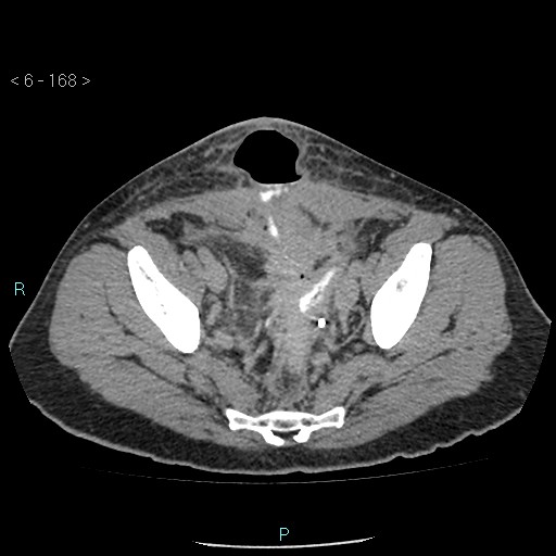 File:Colo-cutaneous fistula (Radiopaedia 40531-43129 A 70).jpg