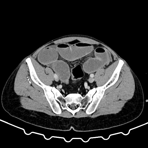 File:Colocolic intussusception due to large lipoma (Radiopaedia 68773-78482 A 152).jpg