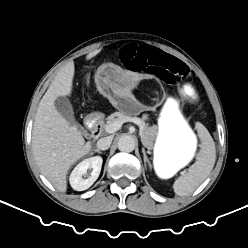 Colocolic intussusception due to large lipoma (Radiopaedia 68773-78482 A 48).jpg