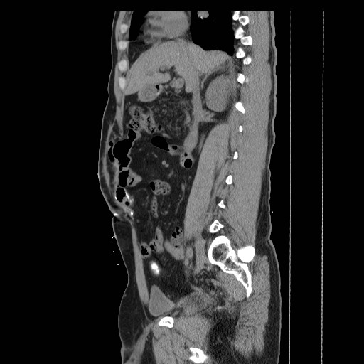 Colocutaneous fistula in Crohn's disease (Radiopaedia 29586-30093 F 7).jpg