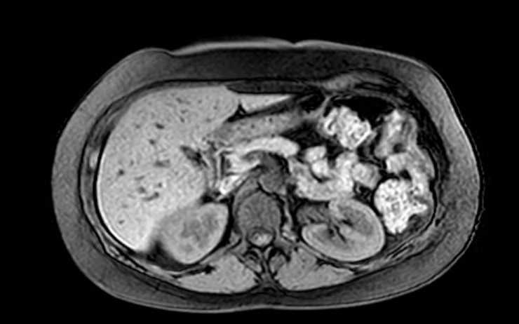 Colon adenocarcinoma with Krukenberg tumors, advanced pregnancy (Radiopaedia 67279-76645 A 58).jpg