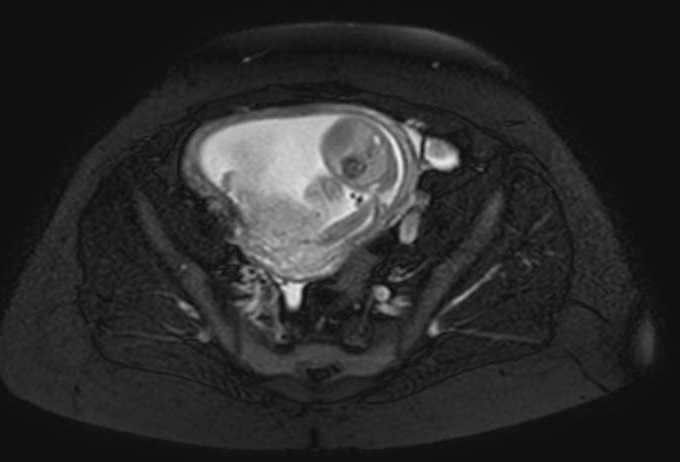 Colon adenocarcinoma with Krukenberg tumors, advanced pregnancy (Radiopaedia 67279-76645 Axial T2 SPAIR 18).jpg