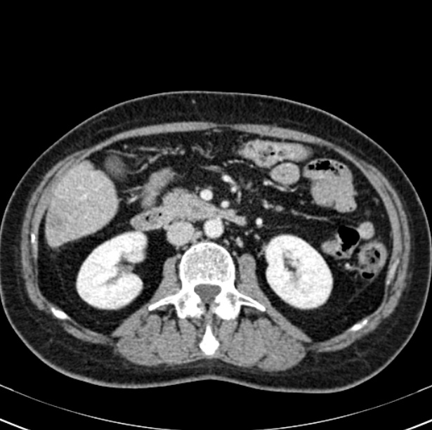 Colon carcinoma with hepatic metastases (Radiopaedia 29477-29961 A 50).jpg