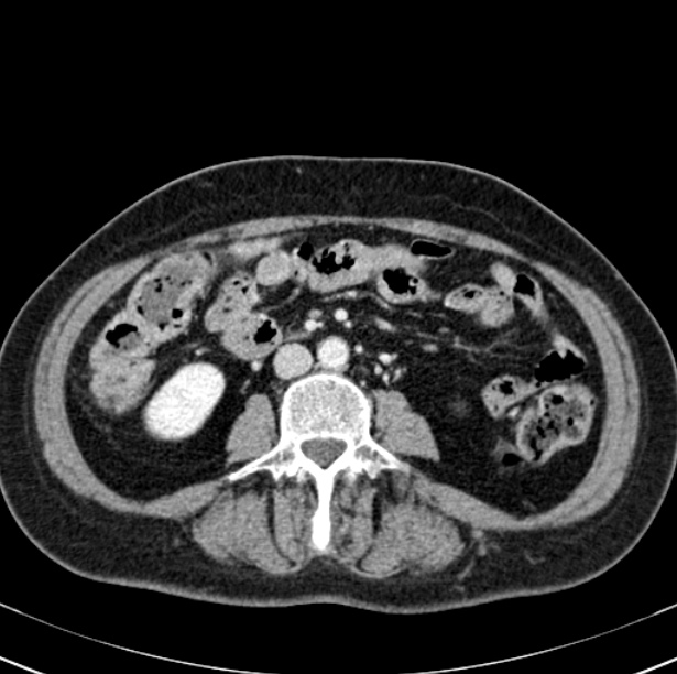Colon carcinoma with hepatic metastases (Radiopaedia 29477-29961 A 61).jpg