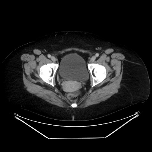 File:Colonic intussusception due to adenocarcinoma (Radiopaedia 86828-102987 A 138).jpg