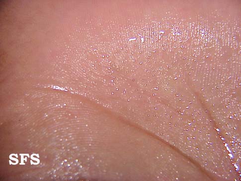 File:Hyperhidrosis (Dermatology Atlas 3).jpg