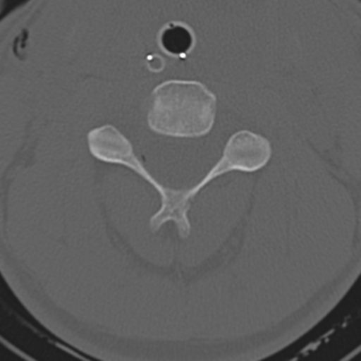File:Multitrauma with diffuse axonal injury, temporal bone fractures and traumatic caroticocavernous fistula (Radiopaedia 37242-39035 Axial 187).png