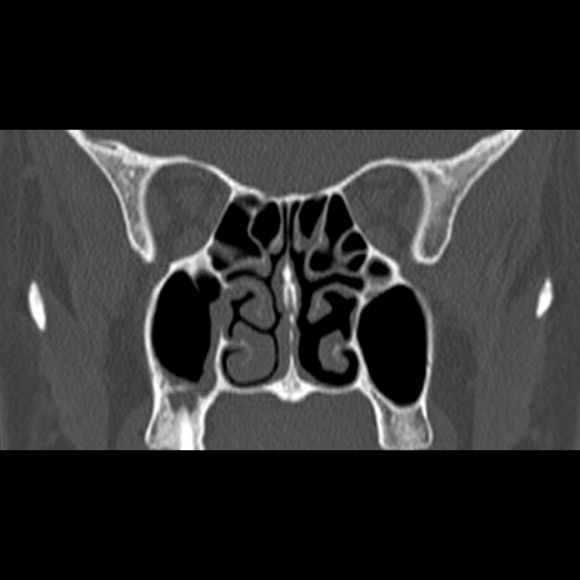 Nasal septal perforation (Radiopaedia 25030-25289 Coronal bone window 42).jpg