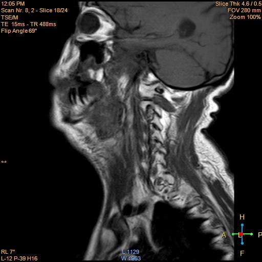 File:Nasopharyngeal carcinoma (Radiopaedia 22375-22403 Sagittal T1 13).jpg