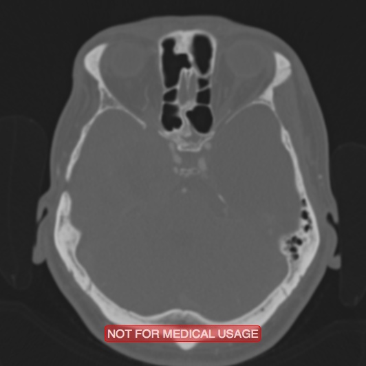 Nasopharyngeal carcinoma recurrence - skull base destruction (Radiopaedia 29107-29490 Axial bone window 73).jpg