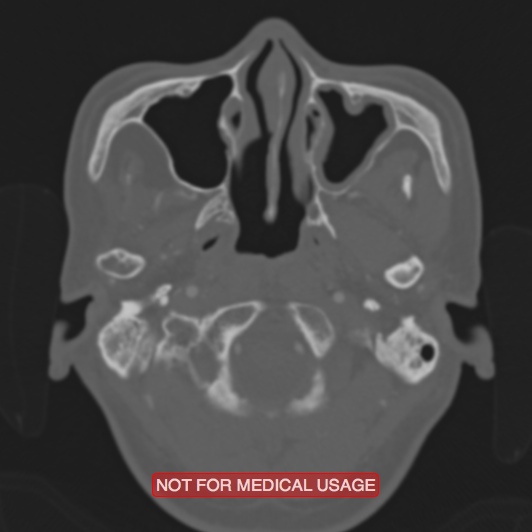 Nasopharyngeal carcinoma recurrence - skull base destruction (Radiopaedia 29107-29490 Axial bone window 95).jpg