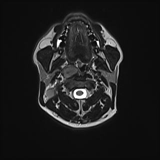 Nasopharyngeal carcinoma with perineural spread (Radiopaedia 55030-61380 Axial T2 39).jpg