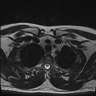 File:Nasopharyngeal carcinoma with perineural spread (Radiopaedia 55030-61380 Axial T2 88).jpg
