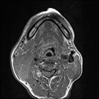 Nasopharyngeal carcinoma with skull base invasion (Radiopaedia 59258-66600 B 43).jpg