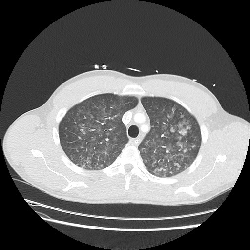 Near-drowning pulmonary edema (Radiopaedia 59457-66814 Axial lung window 15).jpg