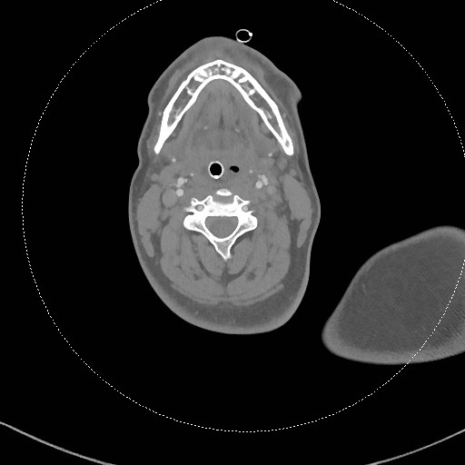 Neck CT angiogram (intraosseous vascular access) (Radiopaedia 55481-61945 B 197).jpg