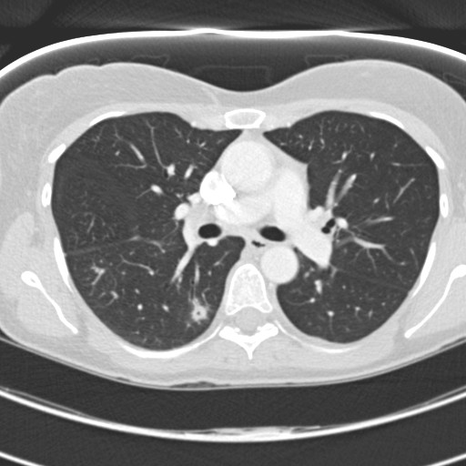 Necrobiotic pulmonary nodules - Crohn disease (Radiopaedia 20723-20631 Axial lung window 59).jpg
