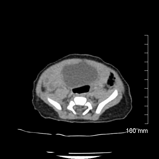 File:Neonatal neuroblastoma (Radiopaedia 56651-63438 Axial non-contrast 61).jpg