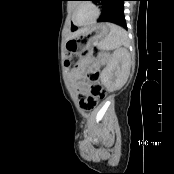 File:Neonatal neuroblastoma (Radiopaedia 56651-63438 C 27).jpg