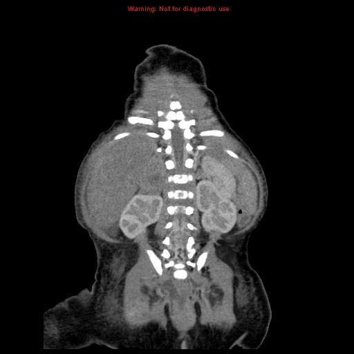 File:Neonatal neuroblastoma (Radiopaedia 9564-10223 B 98).jpg