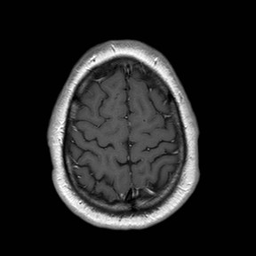 File:Neuro-Behcet's disease (Radiopaedia 21557-21506 Axial T1 C+ 24).jpg