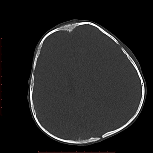 File:Neuroblastoma skull metastasis (Radiopaedia 56053-62683 Axial bone window 17).jpg