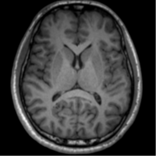 File:Neurofibromatosis type 2 (Radiopaedia 44936-48838 Axial T1 79).png