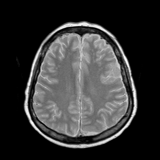File:Neurofibromatosis type 2 (Radiopaedia 8713-9518 Axial Gradient Echo 8).jpg
