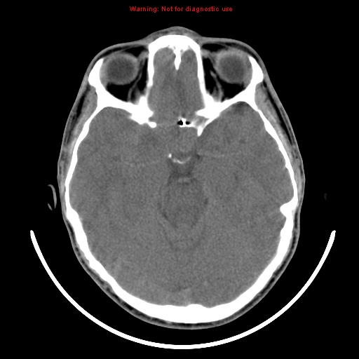 File:Neurofibromatosis type 2 (Radiopaedia 8953-9732 Axial non-contrast 13).jpg