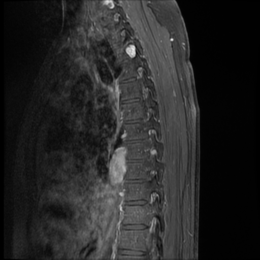 File:Neurofibromatosis type 2 (spinal manifestations) (Radiopaedia 53943-60070 I 10).png
