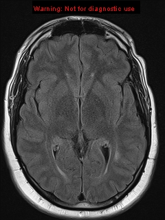 File:Neuroglial cyst (Radiopaedia 10713-11184 Axial FLAIR 12).jpg