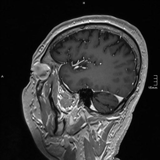 Neurosarcoidosis - involvement of the mesial temporal lobes (Radiopaedia 67429-76820 Sagittal T1 C+ 129).jpg