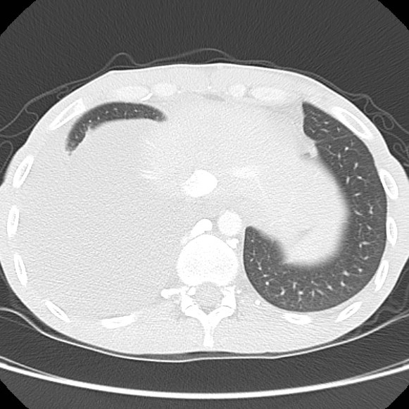 File:Non-Hodgkin lymphoma involving lung (Radiopaedia 29094-29470 Axial lung window 59).jpg
