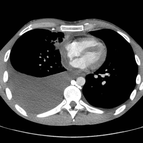 File:Non-Hodgkin lymphoma involving lung (Radiopaedia 29094-29470 B 43).jpg